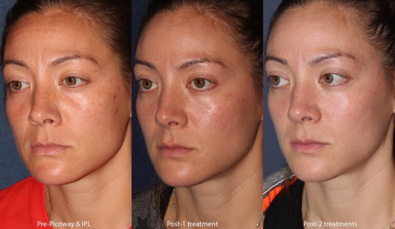 Before and after oblique image of IPL and PicoWay laser treatment on a female's face performed by Dr. Wuat our San Diego medi spa