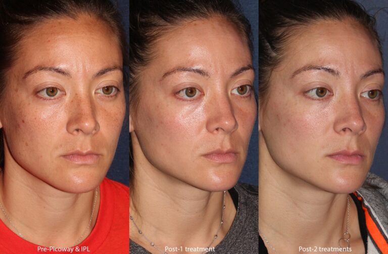 Before and after oblique image of IPL and PicoWay laser treatment on a female's face performed by Dr. Wu at our San Diego medi spa