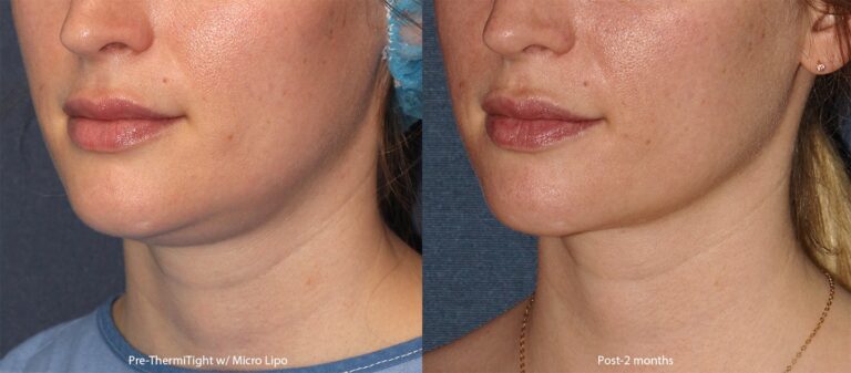 Before and after oblique image of liposculpture and ThermiTight treatment on a female's chin and neck performed by Dr. Groff at our San Diego medical spa