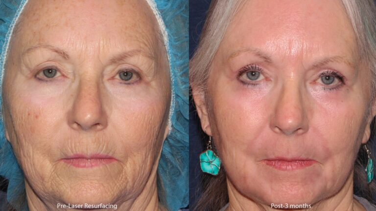 Before and after front image of laser resurfacing treatment on a female's face performed by Dr. Groff at our San Diego medical spa