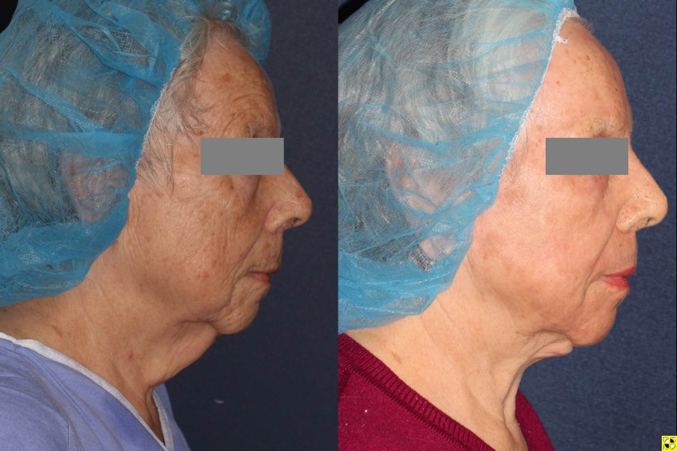 liposculpture myers Facial ft