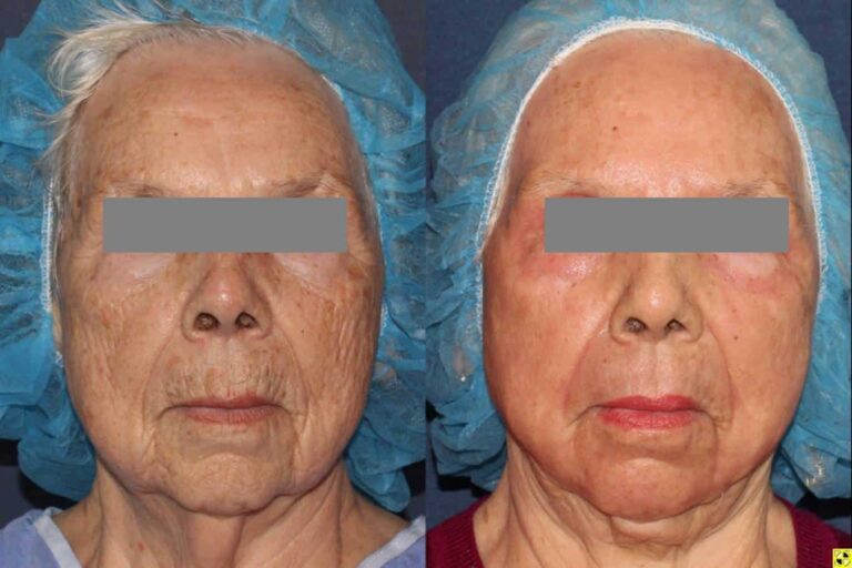 Before and after front image of Erbium Yag, CO2 laser and liposculpture treatment on a female's face, chin, and neck performed by Dr. Boen at our San Diego medical spa