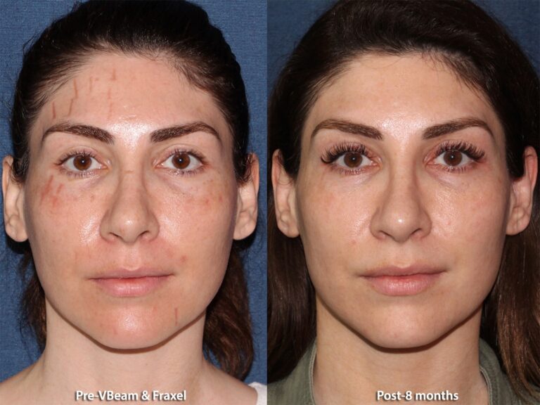Before and after front image of Fraxel and Vbeam laser treatment on a female's face performed by Dr. Groff at our San Diego medical spa