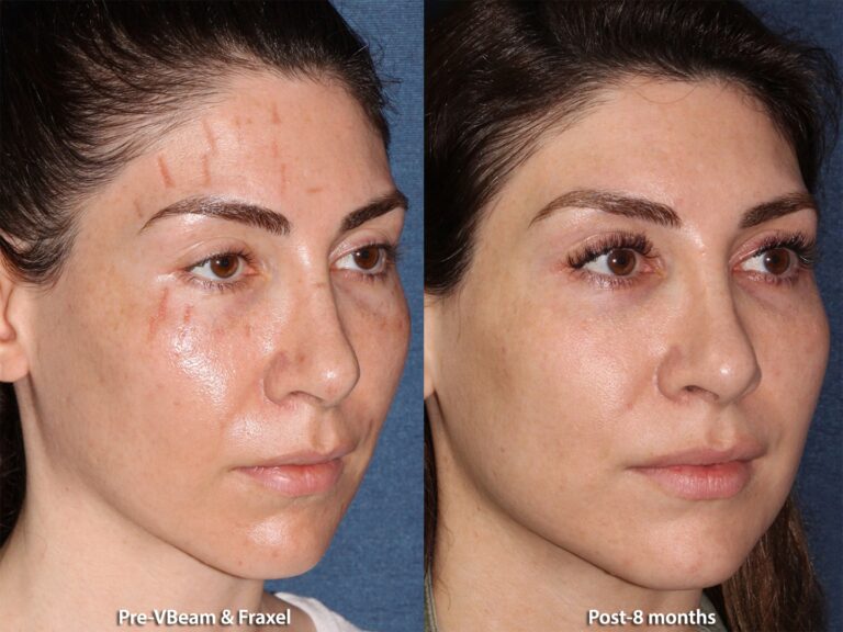 Before and after oblique image of Fraxel and Vbeam laser treatment on a female's face performed by Dr. Groff at our San Diego medical spa