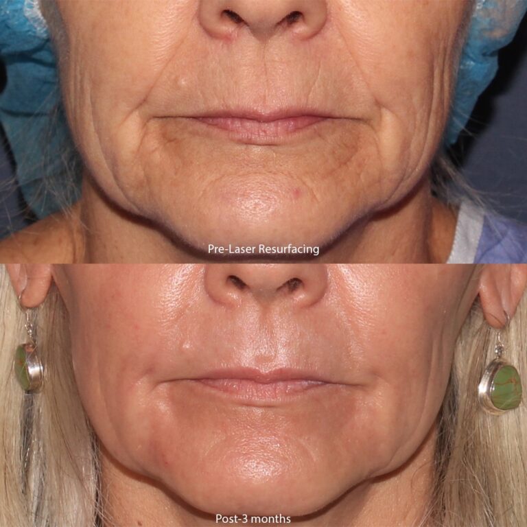 Before and after front image of laser resurfacing treatment on a female's face performed by Dr. Groff at our San Diego medical spa