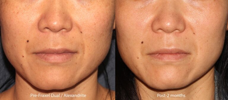 Before and after front image of Fraxel Dual and Alexandrite laser treatment on a female's face performed by Dr. Groff at our San Diego medical spa