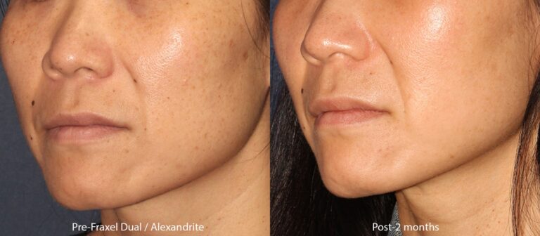 Before and after oblique image of Fraxel Dual and Alexandrite laser treatment on a female's face performed by Dr. Groff at our San Diego medical spa