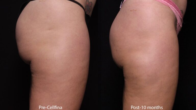 Before and after side image of Cellfina treatment on a female's buttocks performed by Dr. Fabi at our San Diego medical clinic
