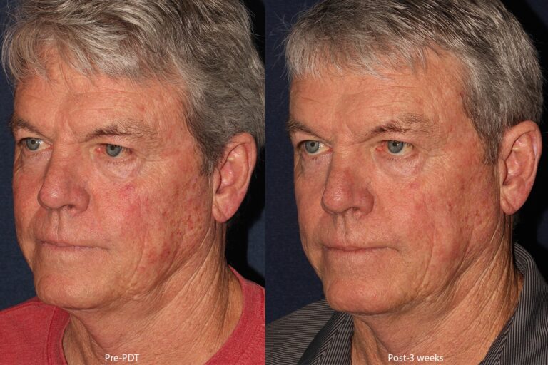Before and after oblique image of photodynamic therapy on a male's face performed by Dr. Wu at our San Diego medical clinic