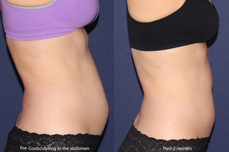 Before and after side image of CoolSculpting treatment on a female's abdomen performed by Leysin Fletcher, PA-C, at our San Diego medical spa