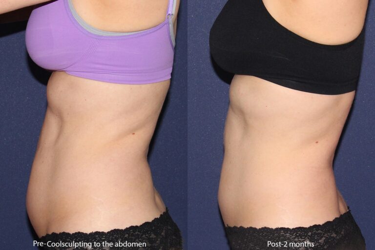 Before and after side image of CoolSculpting treatment on a female's abdomen performed by Leysin Fletcher, PA-C, at our San Diego medical spa