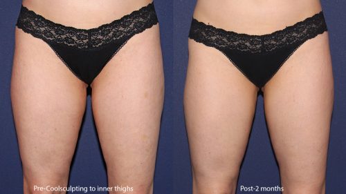 Before and after front image of CoolSculpting treatment on a female's thighs performed by Leysin Fletcher, PA-C, at our San Diego medical spa