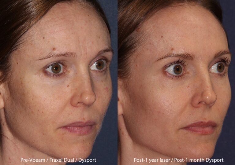 Before and after oblique image of Fraxel Dual, Vbeam and Dysport treatment on a female's face performed by Dr. Fabi at our San Diego medical clinic