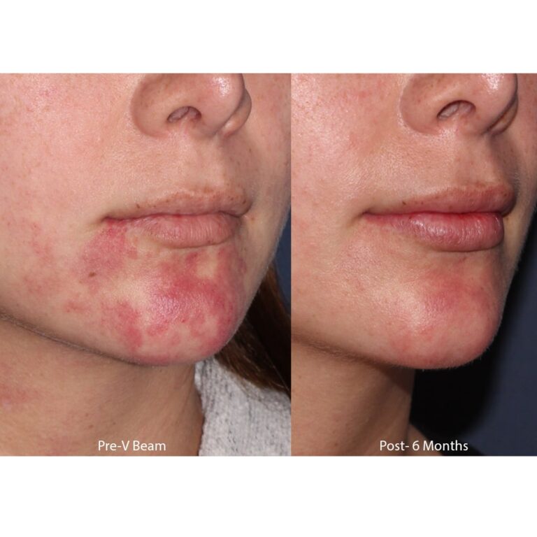 Before and after oblique image of Vbeam treatment on a male's chin for birthmark removal performed by Dr. Groff at our San Diego medical clinic