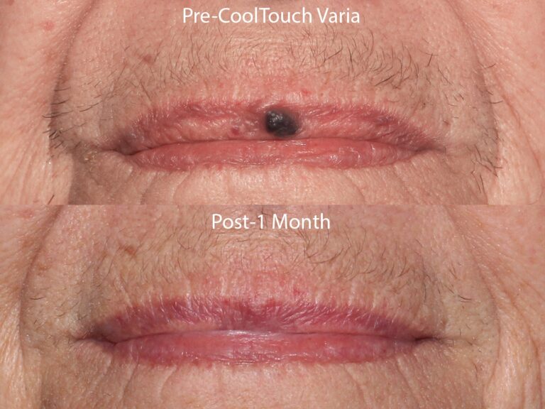 Before and after front image of CoolTouch Varia treatment on a female's lip performed by Dr. Wu at our San Diego medi spa