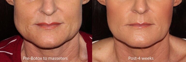 Before and after front image of Botox treatment on a female's masseter muscles performed by Dr. Groff at our San Diego medi spa