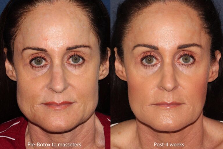 Before and after front image of Botox treatment on a female's masseter muscles performed by Dr. Groff at our San Diego medi spa
