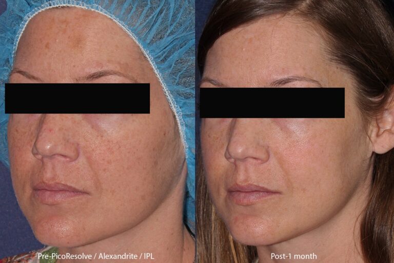 Before and after oblique image of IPL and PicoWay laser treatment on a female's face performed by Dr. Butterwick at our San Diego medi spa