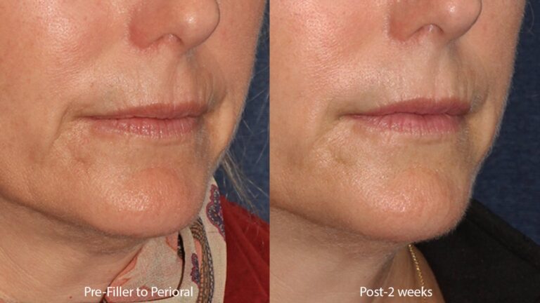 Before and after oblique image of Restylane treatment around a female's mouth performed by Dr. Butterwick at our San Diego medi spa