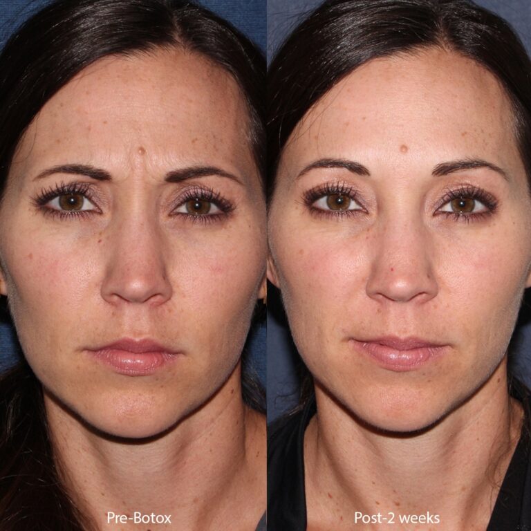 Before and after front image of Botox treatment on a female's frown lines performed by Dr. Groff at our San Diego medical spa