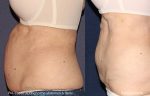 before and after liposuction in san diego, ca