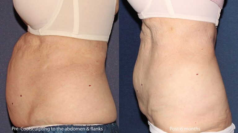 Before and after side image of CoolSculpting treatment on a female's abdomen performed by Leysin Fletcher, PA-C, at our San Diego medical spa