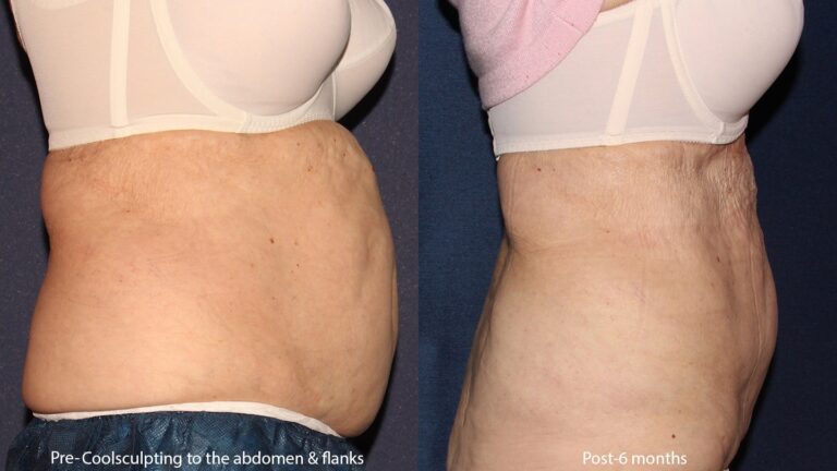 Before and after side image of CoolSculpting treatment on a female's abdomen performed by Leysin Fletcher, PA-C, at our San Diego medical spa