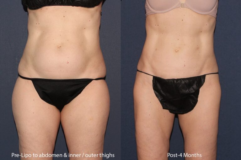 Before and after front image of liposculpture treatment on a female's abdomen, flanks, and thighs performed by Dr. Wu at our San Diego medical spa