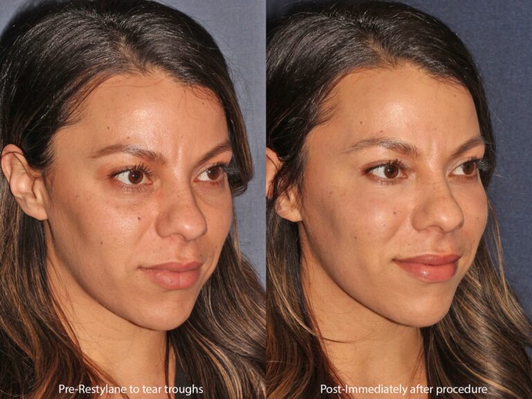 Before and after oblique image of Restylane treatment on a female's tear troughs performed by Dr. Butterwick at our San Diego medical spa