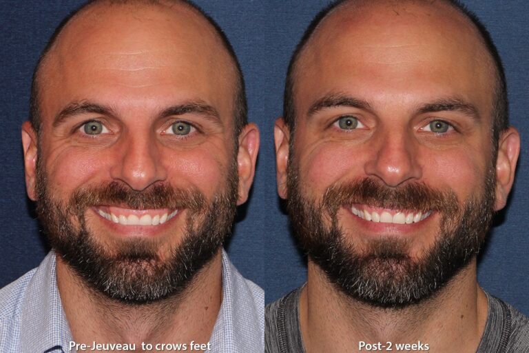 Before and after front image of Jeuveau treatment on a male's crow's feet performed by Dr. Boen at our San Diego med spa