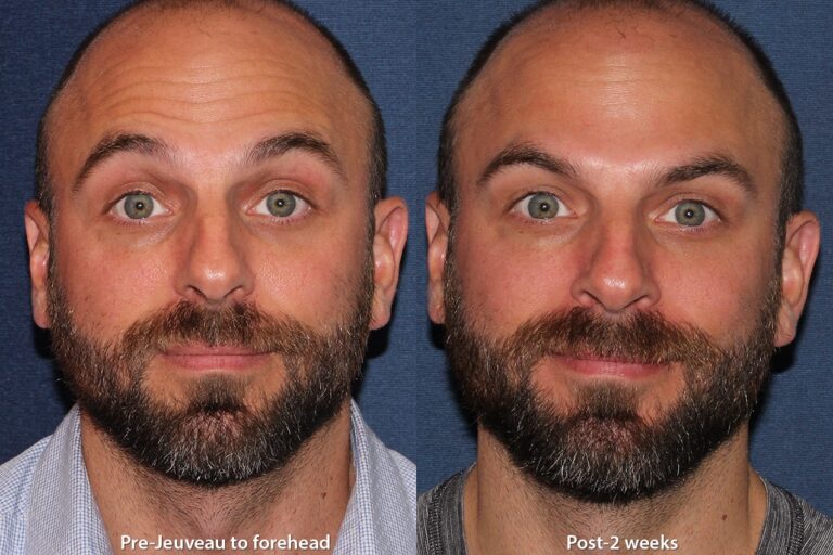 Before and after front image of Jeuveau treatment on a male's forehead lines performed by Dr. Boen at our San Diego med spa