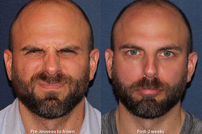 Before and after front image of Jeuveau treatment on a male's frown lines performed by Dr. Boen at our San Diego med spa