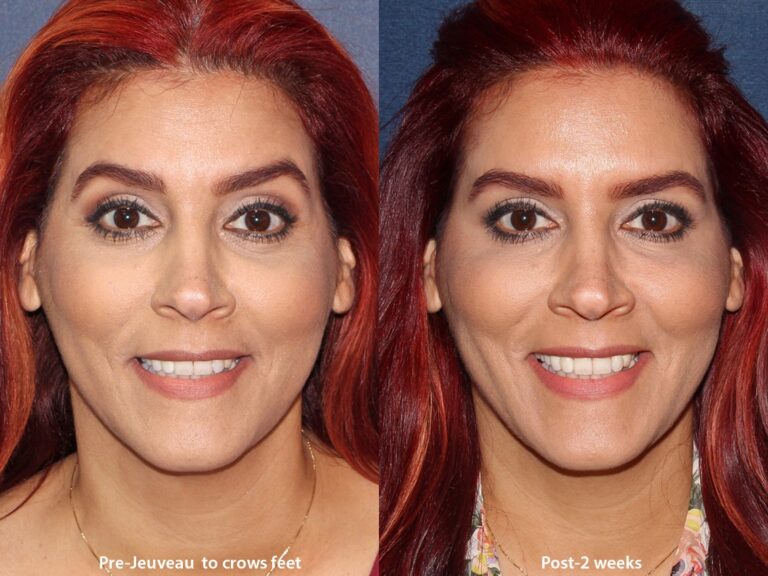 Before and after front image of Jeuveau treatment on a female's forehead lines performed by Dr. Boen at our San Diego med spa
