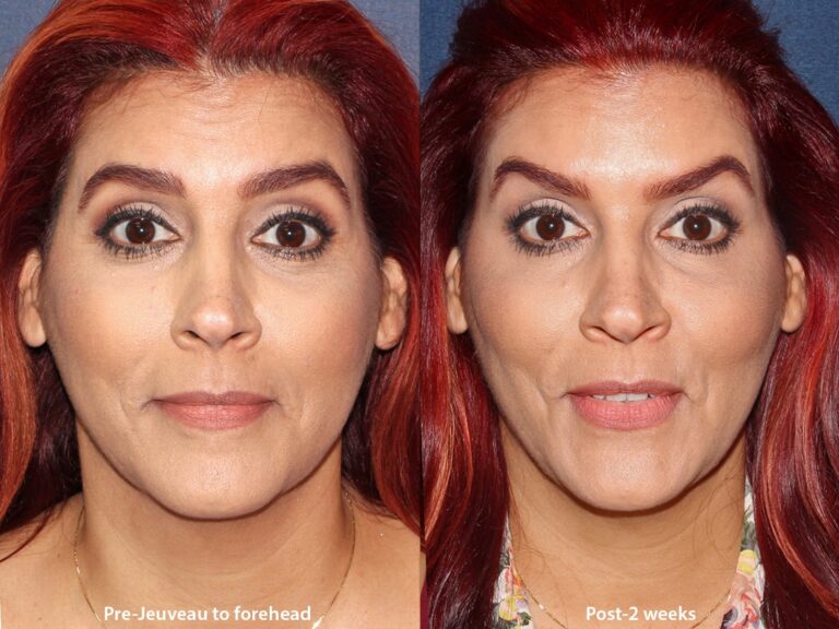 Before and after front image of Jeuveau treatment on a female's forehead lines performed by Dr. Boen at our San Diego med spa