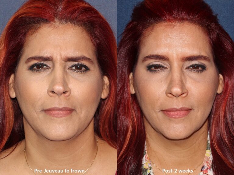 Before and after front image of Jeuveau treatment on a female's frown lines performed by Dr. Boen at our San Diego med spa