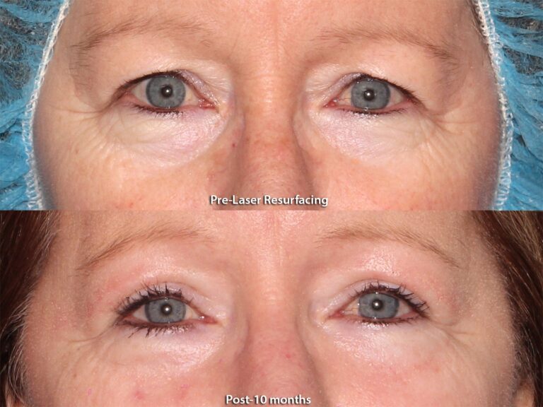 Before and after front image of laser resurfacing treatment on a female's skin around the eyes performed by Dr. Groff at our San Diego medical clinic