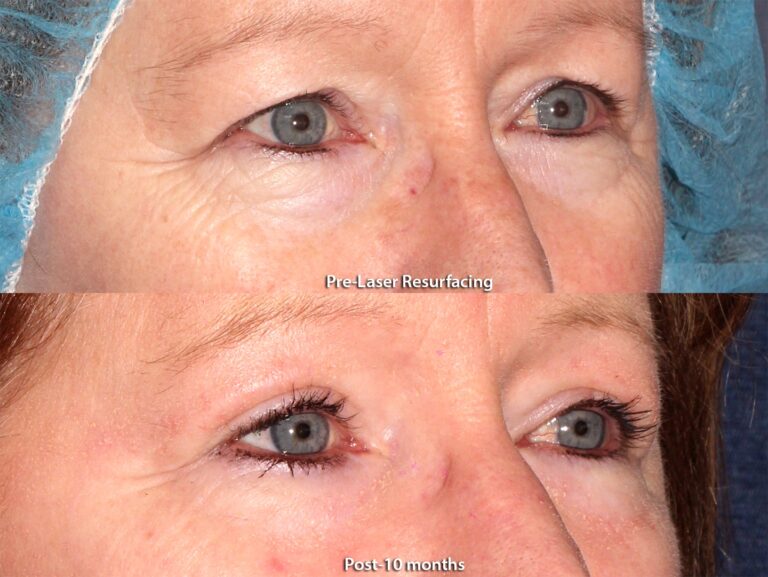 Before and after oblique image of laser resurfacing treatment on a female's skin around the eyes performed by Dr. Groff at our San Diego medical clinic