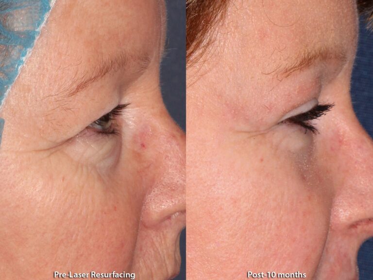 Before and after side image of laser resurfacing treatment on a female's skin around the eyes performed by Dr. Groff at our San Diego medical clinic