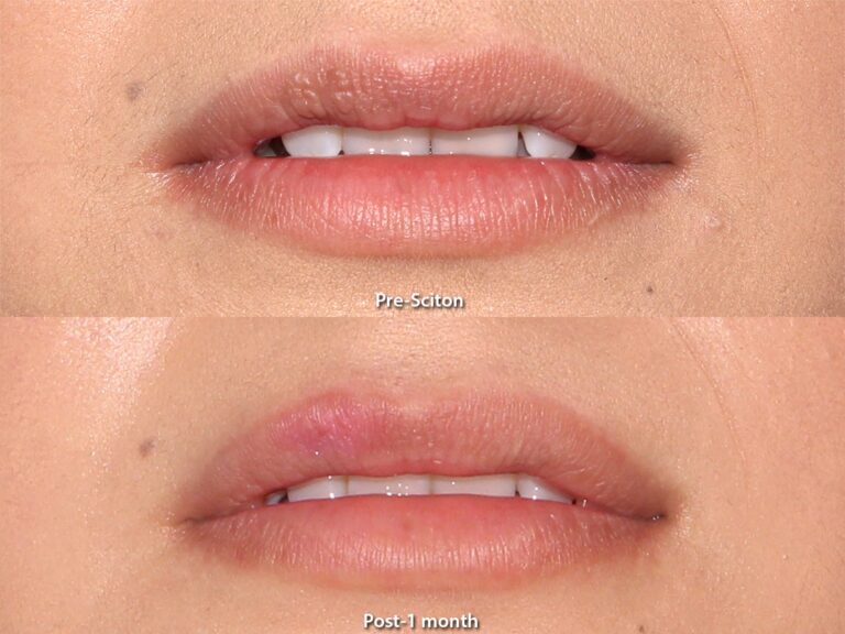 Before and after front image of Sciton laser treatment on a female's lips performed by Dr. Goldman at our San Diego medical spa