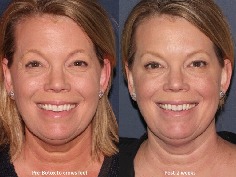 Before and after front image of Botox treatment on a female's upper face performed by Dr. Wu at our San Diego medical clinic