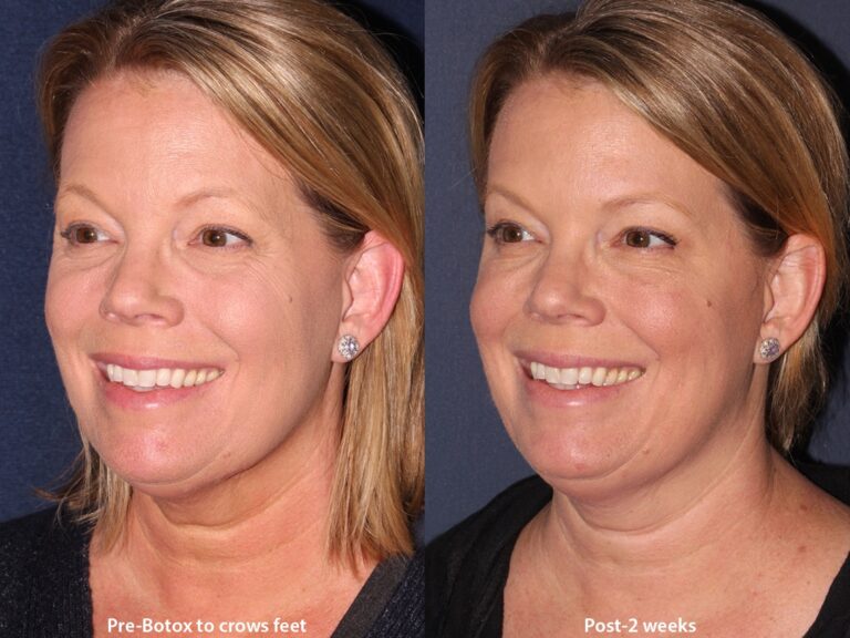Before and after oblique image of Botox treatment on a female's crow's feet performed by Dr. Wu at our San Diego medical clinic