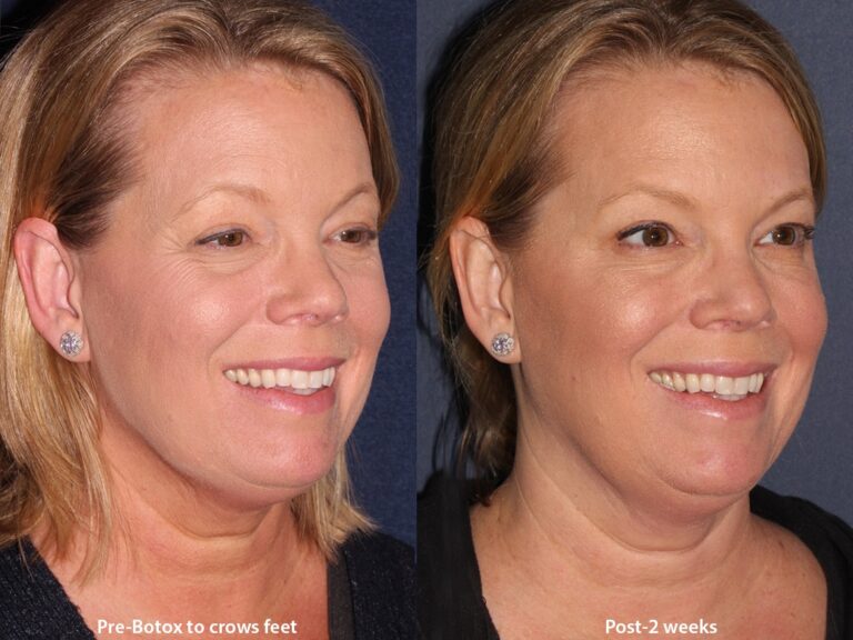 Before and after oblique image of Botox treatment on a female's crow's feet performed by Dr. Wu at our San Diego medical clinic