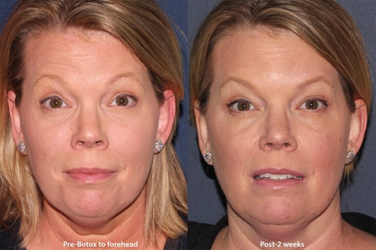 Before and after front image of Botox treatment on a female's forehead lines performed by Dr. Wu at our San Diego medical clinic