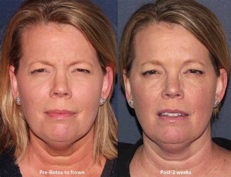 Before and after front image of Botox treatment on a female's frown lines performed by Dr. Wu at our San Diego medical clinic