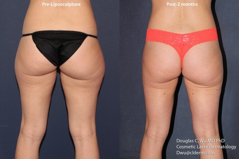 Before and after back image of liposculpture treatment on a female's buttocks and thighs performed by Dr. Wu at our San Diego medical spa