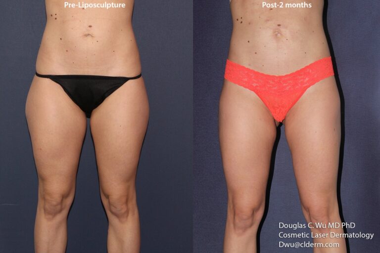 Before and after front image of liposculpture treatment on a female's abdomen and thighs performed by Dr. Wu at our San Diego medical spa