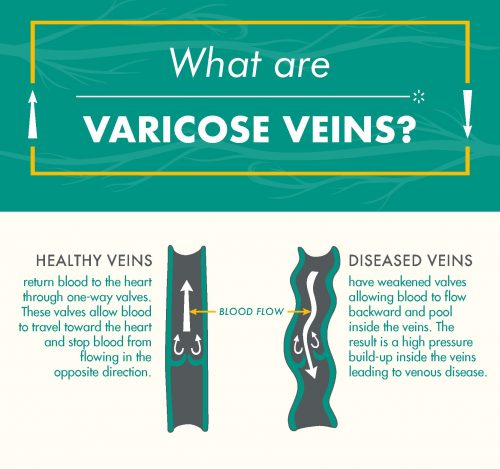 An infographic showing and explaining what Varicose Veins are, San Diego, CA. 