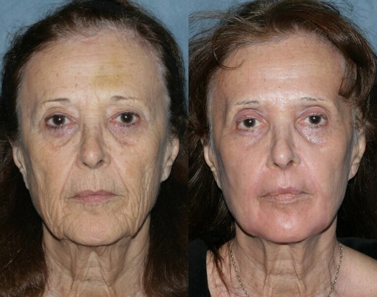 Before and after front image of Take 10 treatment on a female's face performed by Dr. Groff at our San Diego medical clinic