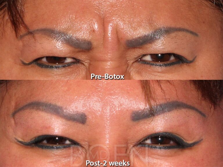 Before and after front image of Botox injections on a female's frown lines performed by Dr. Boen at our San Diego medical spa