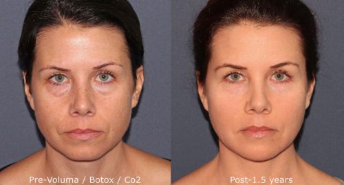 Voluma and Botox Before and After Results